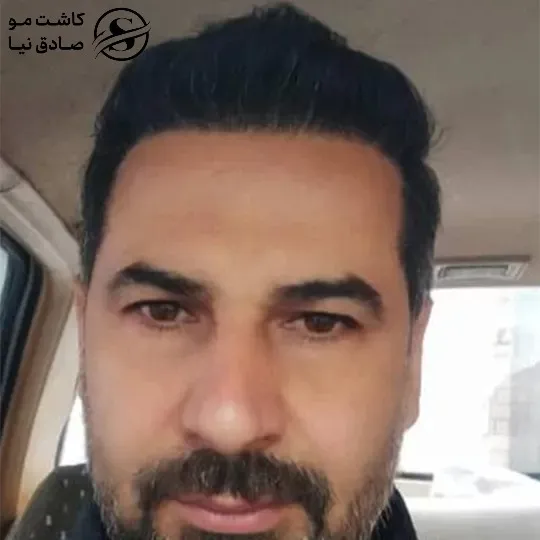 مشتری کاشت مو دو