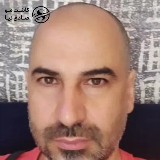 مشتری کاشت مو دو