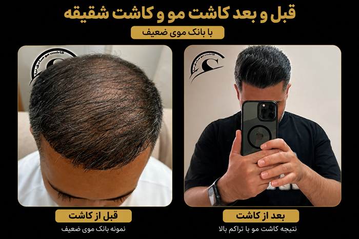 بانک مو چیست و چه نقشی در موفقیت کاشت مو دارد؟ (راهنمای کامل) 3 عکس بانک موی ضعیف