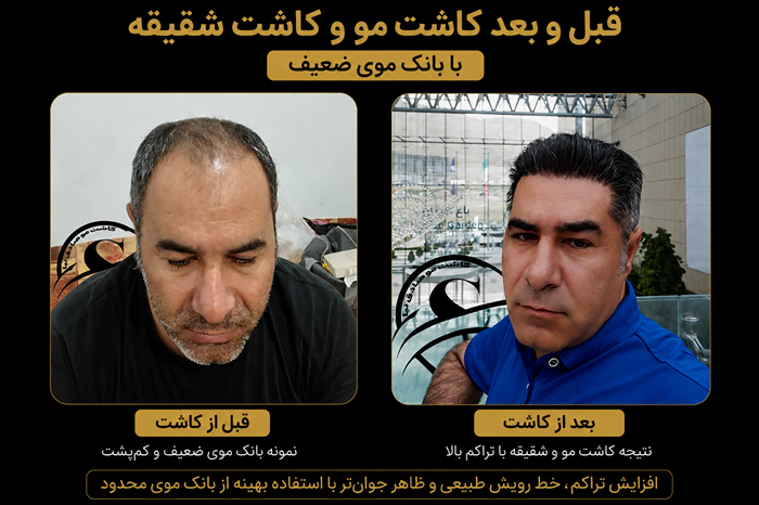 بانک مو چیست و چه نقشی در موفقیت کاشت مو دارد؟ (راهنمای کامل) 4 عکس نمونه عکس بانک موی ضعیف
