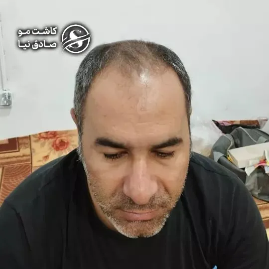 مشتری کاشت مو پنج