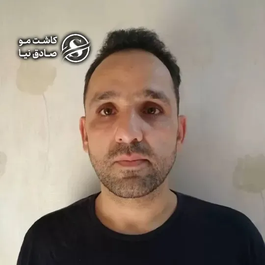 before-and-after-hair-transplant-photos-nine