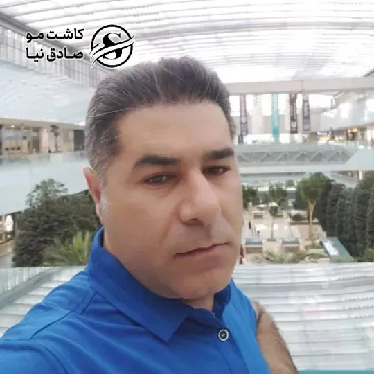 مشتری کاشت مو چهار