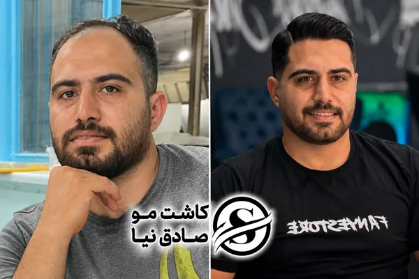 کاشت مو شیراز ۱۴۰۵| مشاوره رایگان، تجربه واقعی مراجعان + شرایط ویژه اقساط با خانم صادق نیا 6 عکس قبل و بعد کاشت مو شیراز نتیجه واقعی مراجعه_کننده