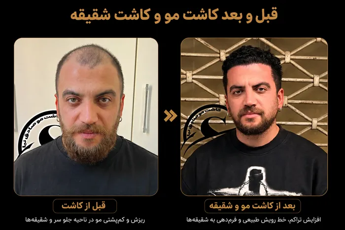 کاشت مو شیراز ۱۴۰۵| مشاوره رایگان، تجربه واقعی مراجعان + شرایط ویژه اقساط با خانم صادق نیا 1 قبل و بعد از کاشت مو و کاشت شقیقه