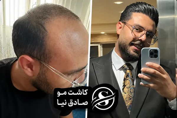کاشت مو شیراز ۱۴۰۵| مشاوره رایگان، تجربه واقعی مراجعان + شرایط ویژه اقساط با خانم صادق نیا 7 نمونه واقعی قبل و بعد کاشت مو در شیراز با طراحی خط رویش طبیعی