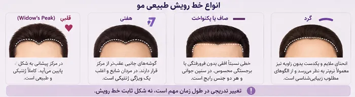 انواع خط رویش مو