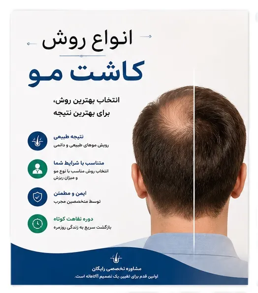 انواع روش کاشت مو | مقایسه کامل روشهای FUT، FUE، SUT و جدیدترین تکنیکها در ایران 1 انواع روش کاشت مو در شیراز