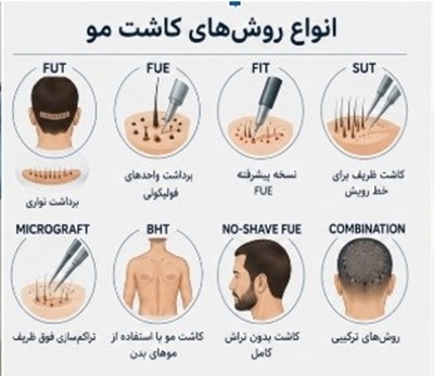 انواع روش‌های کاشت مو