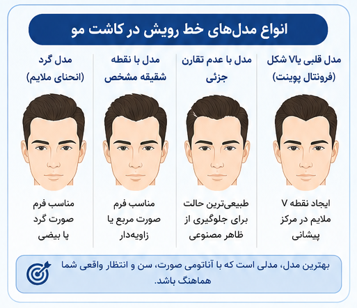 طراحی خط رویش در کاشت مو؛ اصول طبیعی شدن نتیجه و هزینه آن در شیراز 3 انواع مدل خط رویش در کاشت مو