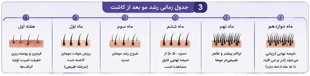 کاشت مو بدون تراشیدن سر در شیراز | آیا بدون اصلاح کامل مو میتوان کاشت انجام داد؟ 5 جدول زمانی رشد مو بعد از کاشت مو بدون تراشیدن