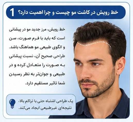 طراحی خط رویش در کاشت مو؛ اصول طبیعی شدن نتیجه و هزینه آن در شیراز 1 خط رویش در کاشت مو چیست؟