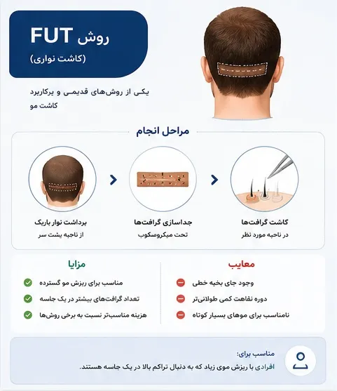 انواع روش کاشت مو | مقایسه کامل روشهای FUT، FUE، SUT و جدیدترین تکنیکها در ایران 4 روش کاشت مو fut در شیراز