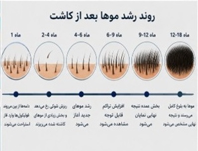 روند رشد موها بعد از کاشت