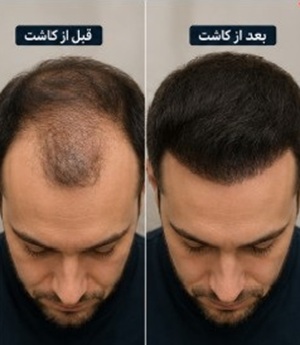 قبل و بعد از کاشت مو