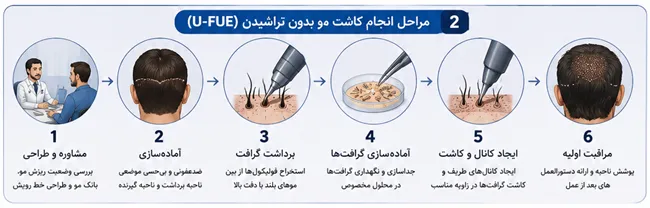 کاشت مو بدون تراشیدن سر در شیراز | آیا بدون اصلاح کامل مو میتوان کاشت انجام داد؟ 4 مراحل انجام کاشت مو بدون تراشیدن