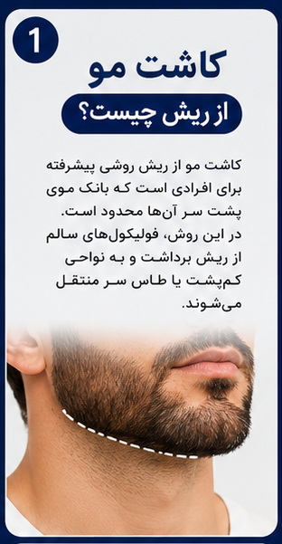 کاشت مو از ریش؛ راهکاری موثر برای افرادی با بانک موی محدود! 1 کاشت مو از ریش چیست؟