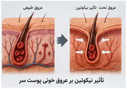 تاثیر نیکوتین بر عروق خونی پوست سر