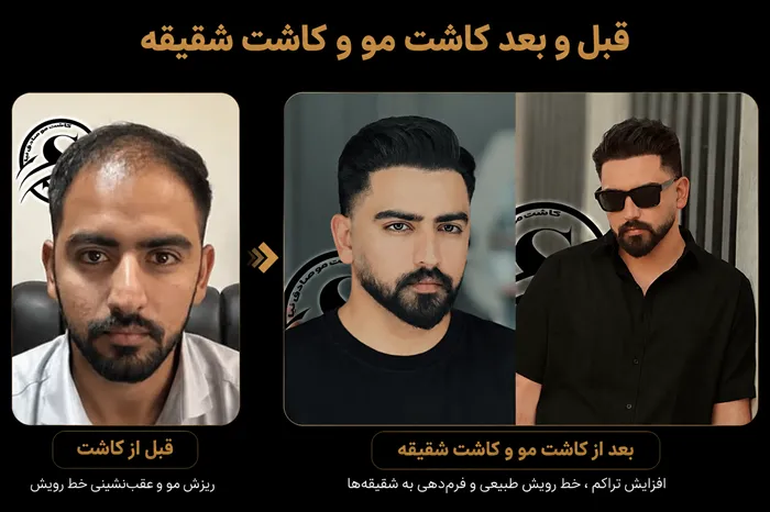 کاشت شقیقه با روش میکرو FIT در شیراز | کاشت مو شقیقه صادقنیا 3 عکس قبل و بعد از کاشت مو و کاشت شقیقه در شیراز