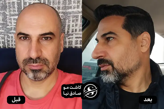کاشت شقیقه با روش میکرو FIT در شیراز | کاشت مو شقیقه صادقنیا 2 عکس قبل و بعد کاشت مو و کاشت شقیقه در شیراز