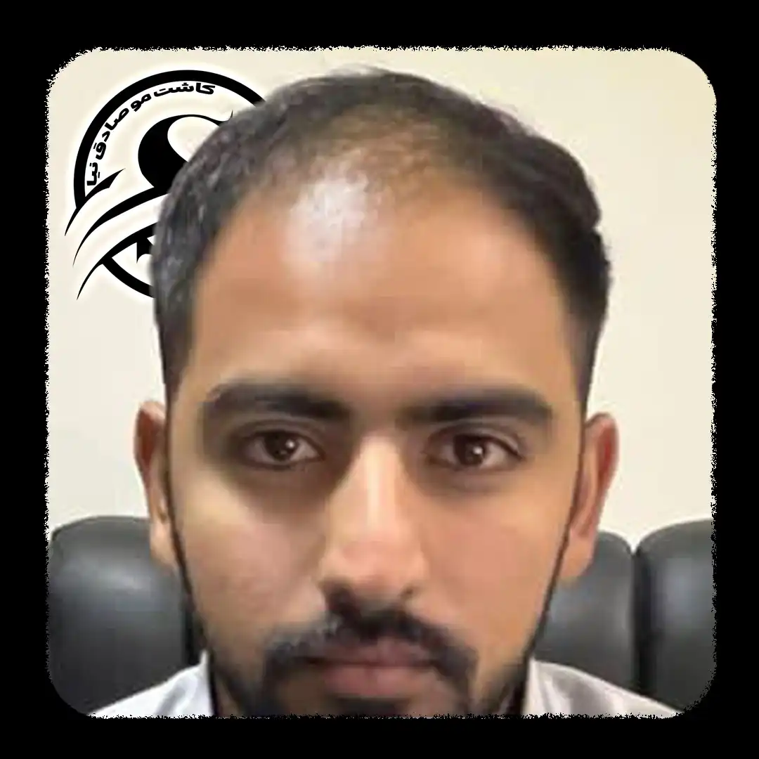 عکس قبل کاشت مو شیراز