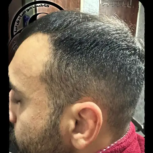 قبل از کاشت مو و کاشت شقیقه