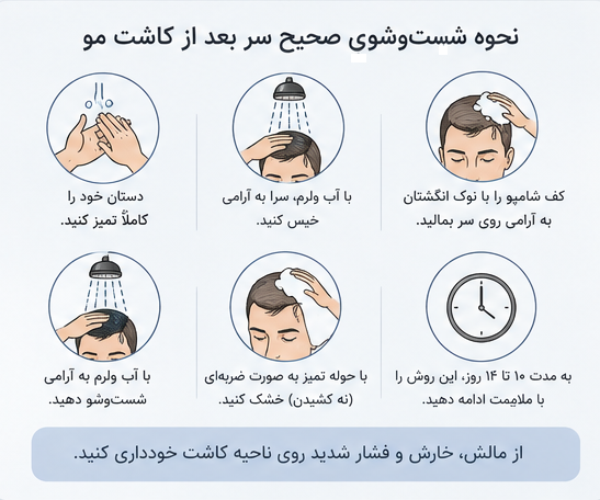 کاشت شقیقه با روش میکرو FIT در شیراز | کاشت مو شقیقه صادقنیا 6 نحوه شستشوی کاشت شقیقه بعد از عمل
