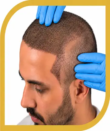 کاشت مو شیراز با تراکم بالا و طراحی خط رویش طبیعی و شقیقه مطابق با خواب مو